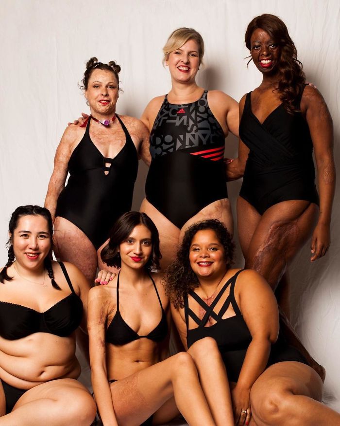 I Started This Campaign To Encourage People Love Themselves With All Their Differences 1