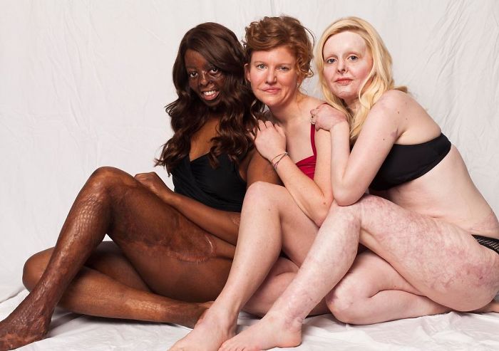 I Started This Campaign To Encourage People Love Themselves With All Their Differences 14