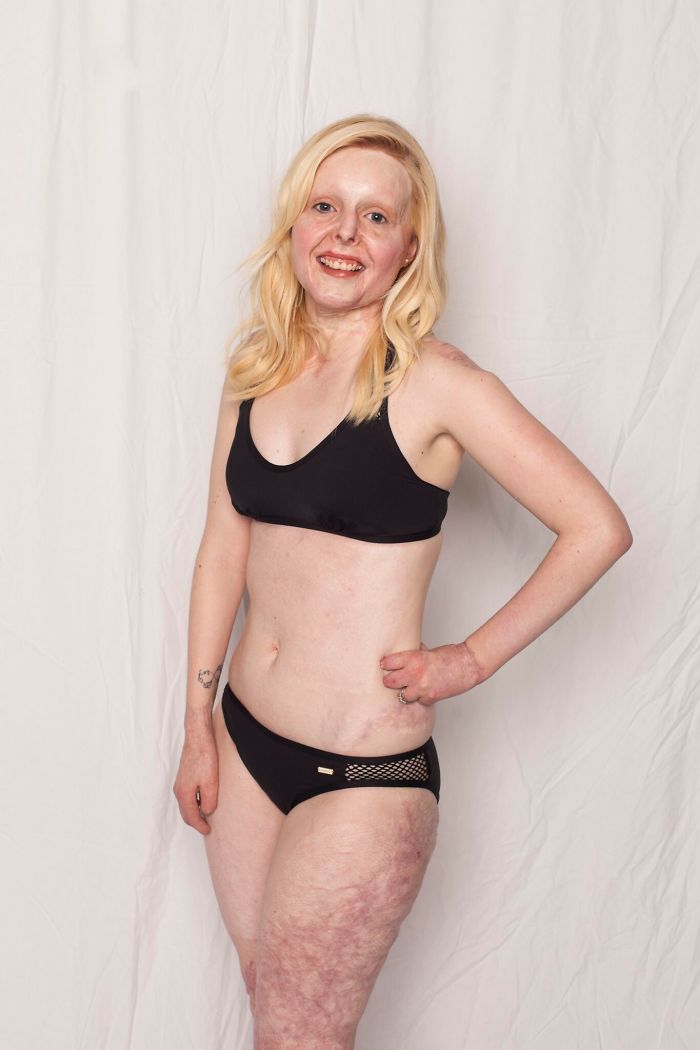 I Started This Campaign To Encourage People Love Themselves With All Their Differences 15