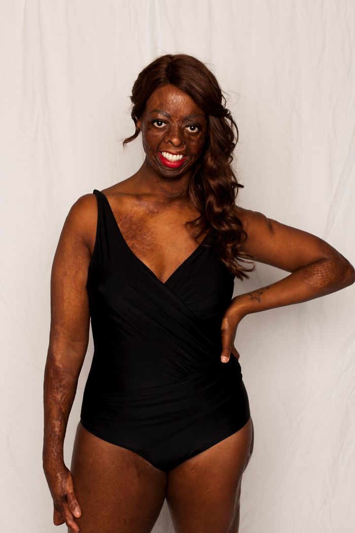 I Started This Campaign To Encourage People Love Themselves With All Their Differences 5