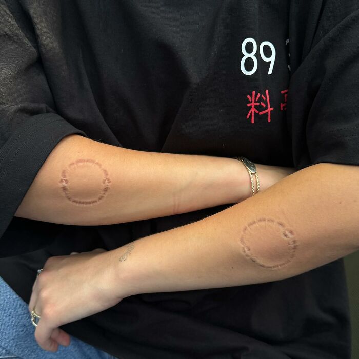 “I’m Drooling”: Billie Eilish Reveals Mystery Bite Marks Along With Rare Bikini Post 3