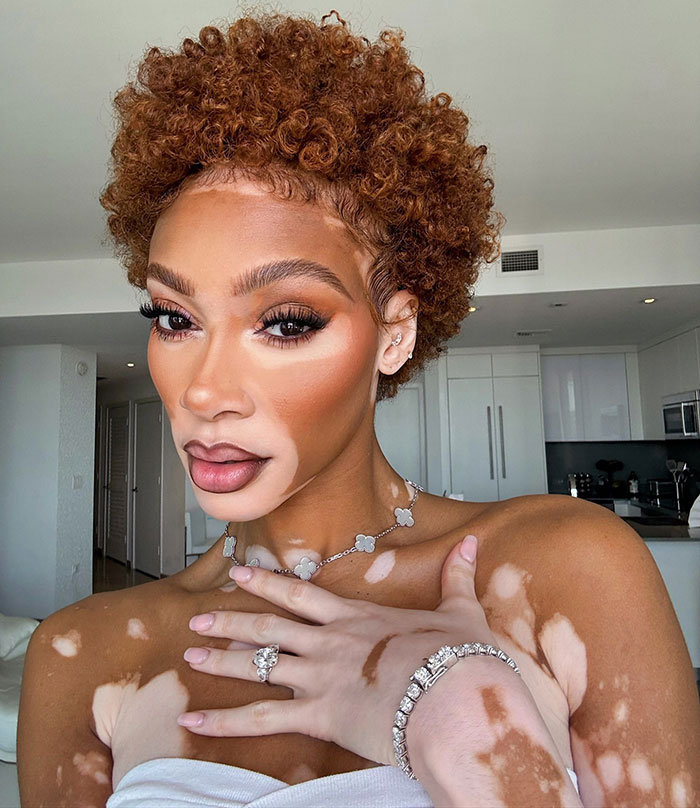 “Michael Jackson Probably Would’ve Been Fascinated By Her”: 31-Year-Old Winnie Harlow Goes Viral 1