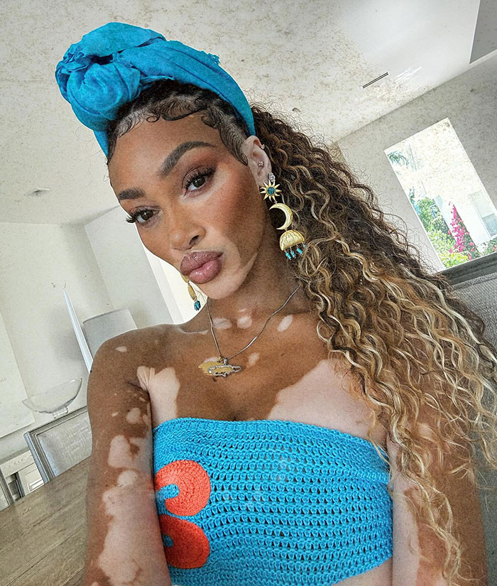 “Michael Jackson Probably Would’ve Been Fascinated By Her”: 31-Year-Old Winnie Harlow Goes Viral 6