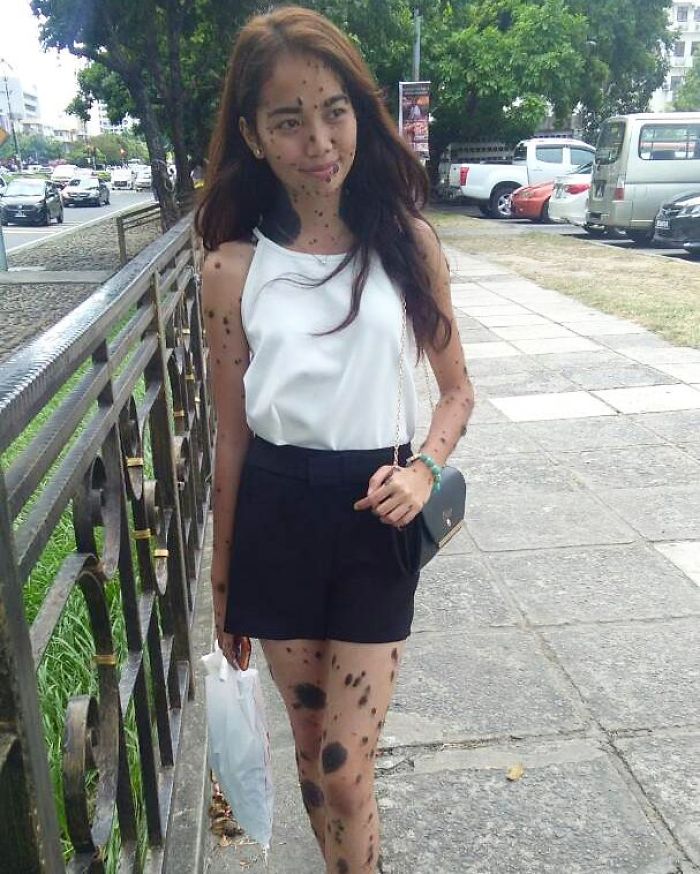 Woman Who Was Called A Monster For Her Head-To-Toe Hairy Moles Might Be The Next Miss Universe 2