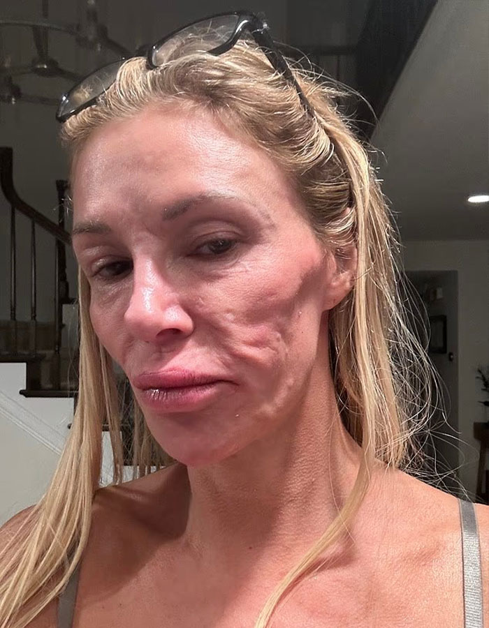 “Psychosis On Display”: Brandi Glanville Goes Bold In Red Bikini After Face Disfigurement Diagnosis 6